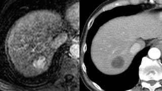 irchemoemboltransarterial3