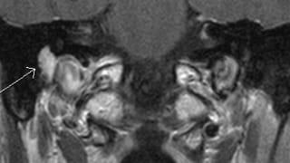 mriauditoarycanals1