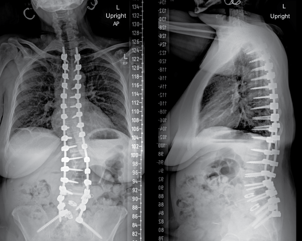 After spinal deformity correction, post-operative X-rays show a patient standing up straight. The screws, rods and spacers help to brace their skeleton internally and maintain their posture.