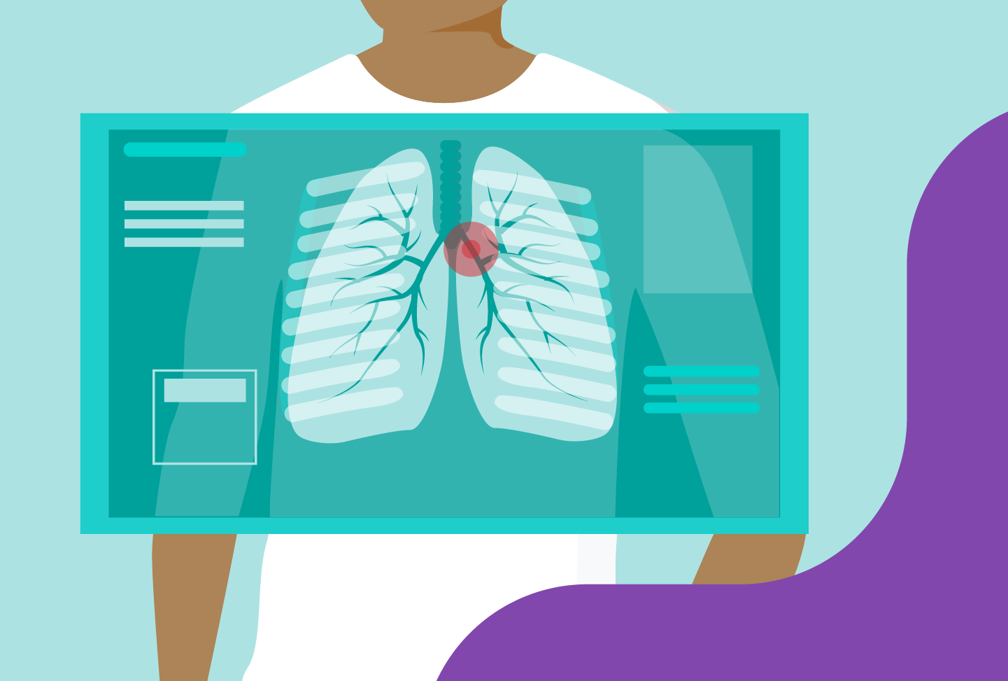 Illustration of a lung scan