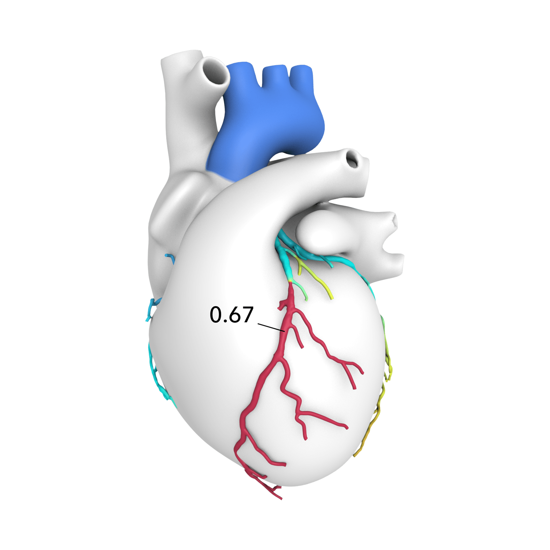 A leading edge technology called HeartFlow Analysis combines CT imaging with powerful computer algorithms to create a personalized, color coded 3D model of coronary arteries.