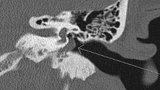 CT of the Temporal Bones Without Contrast